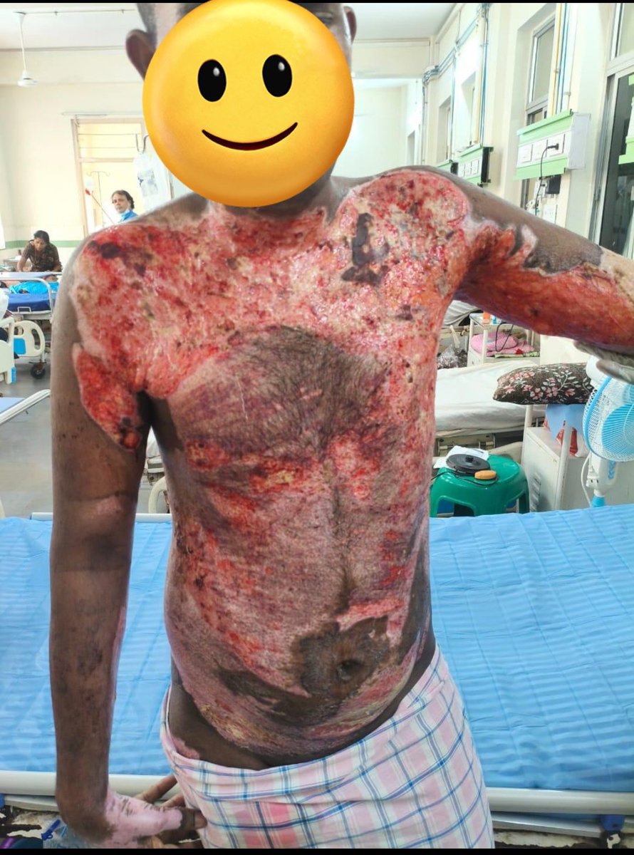 ManeeshhhNTR's tweet photo. Respected Hon'ble CM @ncbn garu and @naralokesh garu
Vijay, a student from a poor family, suffered a severe electrocution accident and is undergoing multiple skin graft surgeries.He is still hospitalized and urgently needs financial assistance for his treatment.

Please help 🙏🏻 https://t.co/W3kXJwxNfF