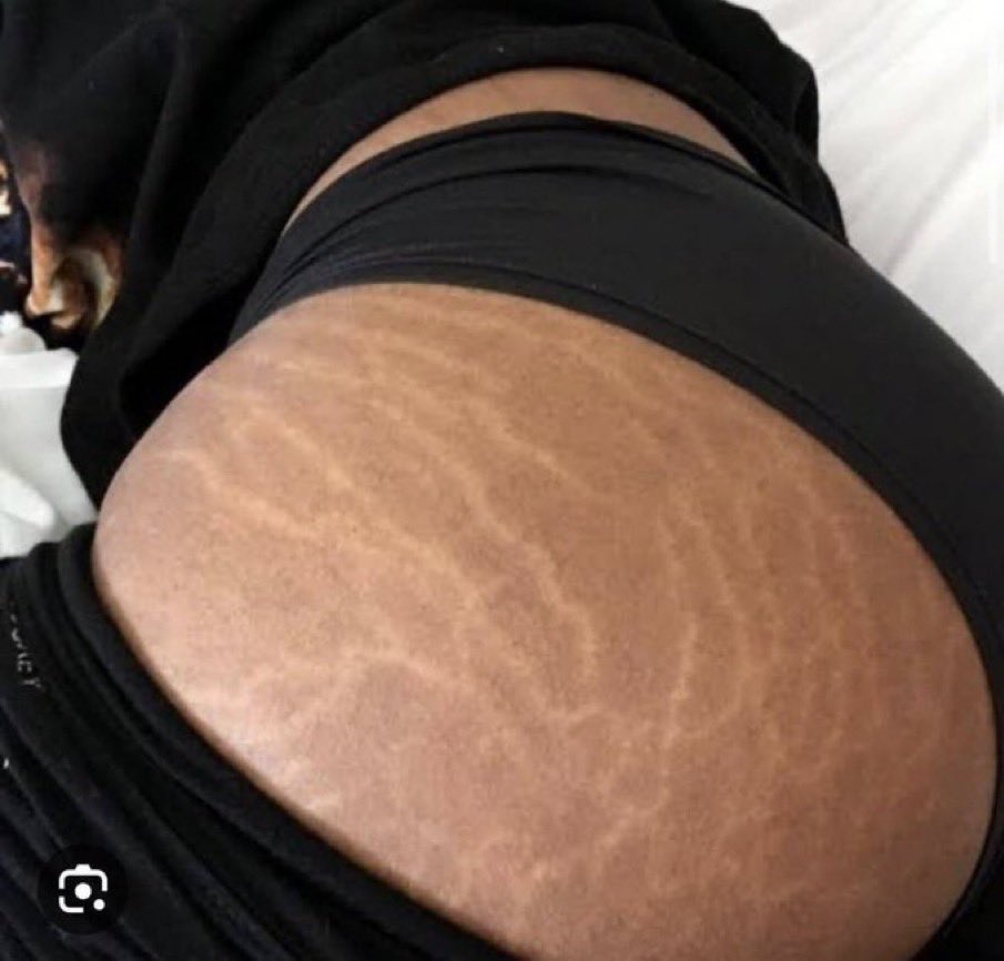 Apremunit's tweet photo. Ladies please try and get rid of stretch marks men don’t fancy them https://t.co/DUExjIAg0L