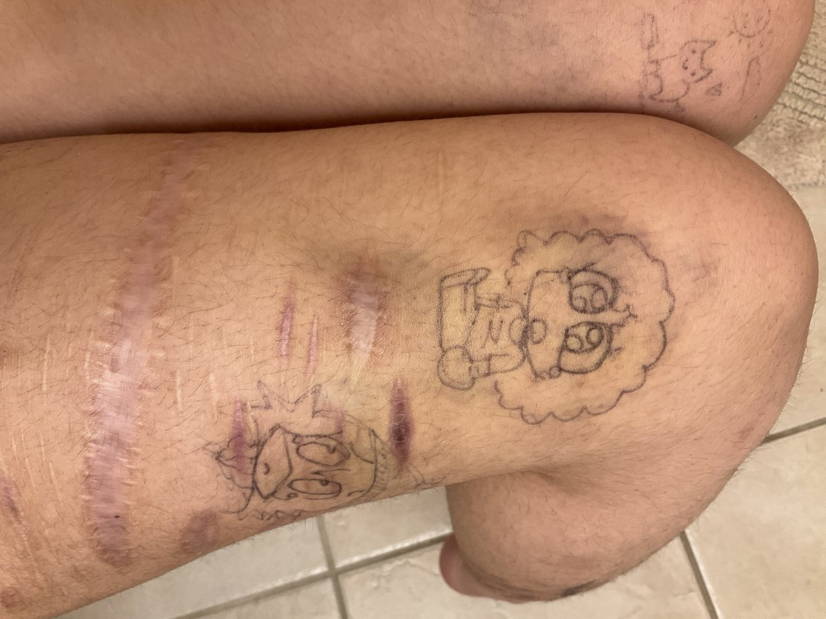 TheApple55588's tweet photo. bruises. might give me sum more today idk #bruisetwt #ouchietwt https://t.co/hiPR7UA2C9