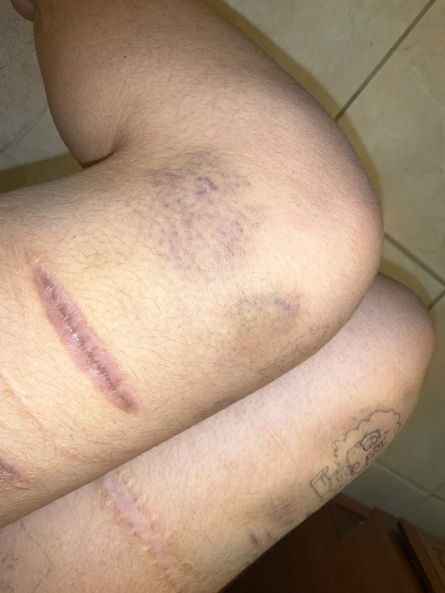 TheApple55588's tweet photo. bruises. might give me sum more today idk #bruisetwt #ouchietwt https://t.co/hiPR7UA2C9