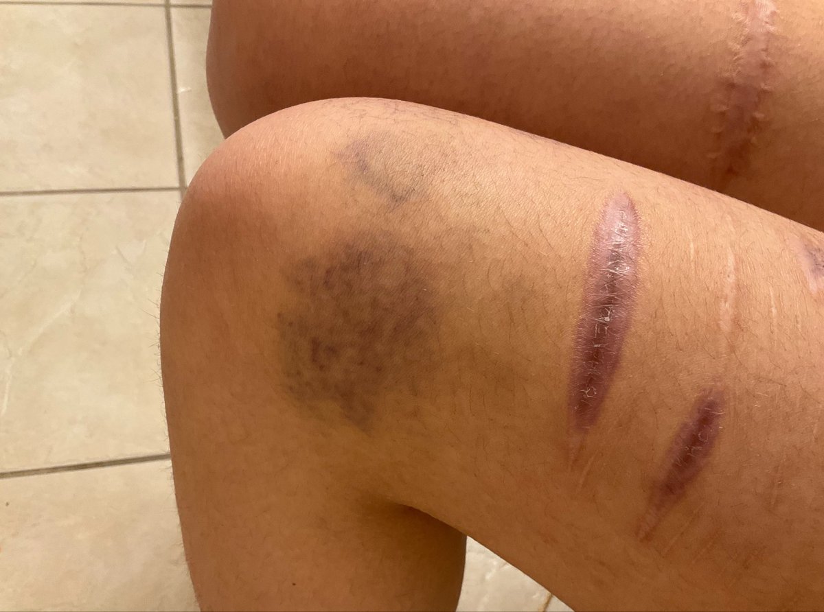 TheApple55588's tweet photo. bruises. might give me sum more today idk #bruisetwt #ouchietwt https://t.co/hiPR7UA2C9