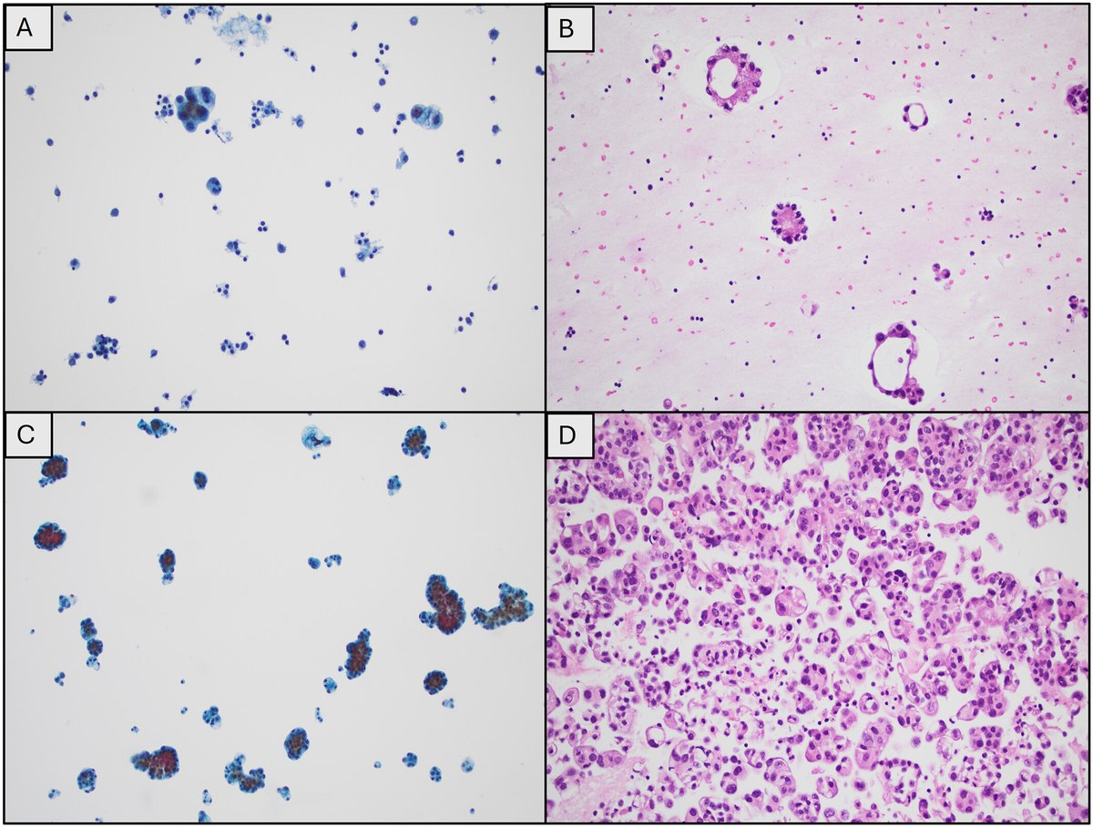 CancerCytopath's tweet photo. 🆕🔬 New and #OpenAccess! Molecular profiling of breast cancer pleural effusions using cytology specimens: Impact of sample source and cytological features on next-generation sequencing performance

https://t.co/pAq68H6IWQ

#CytoPath #BreastPath @cwru https://t.co/HkLIWszFBW