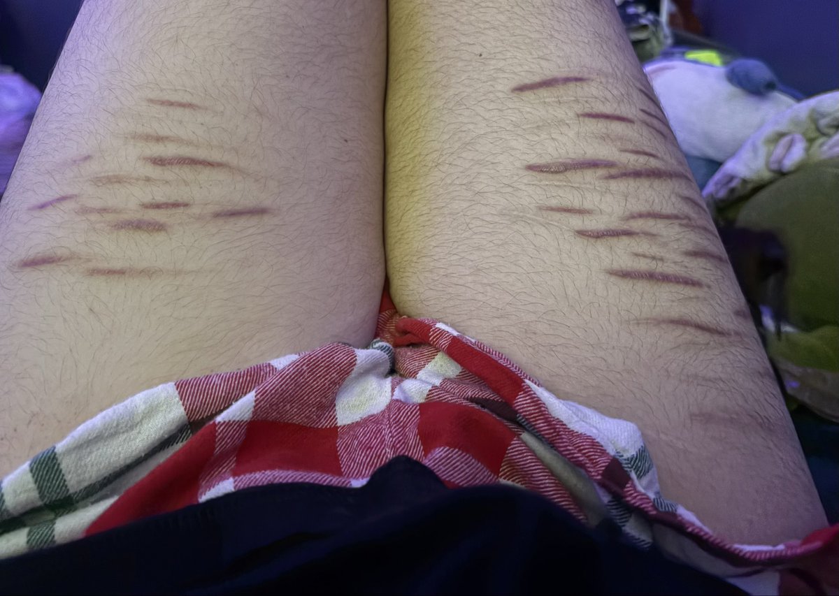 EVILkohane's tweet photo. my thigh scars are my favorite ! ! yes i’m fat gng🫩🥀

NOT ENCOURAGING 
ALL HEALED
NOT AGAINST TOS

#shtw https://t.co/22rhRRttmT