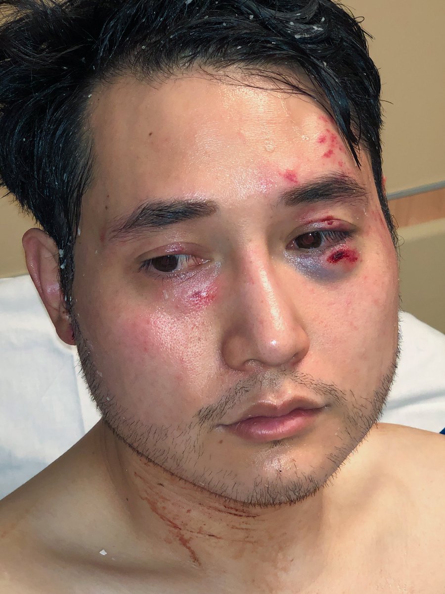 MrAndyNgo's tweet photo. Seven years ago in Portland, Ore.

None of the Antifa attackers who nearly killed me (I suffered a subarachnoid brain hemorrhage) were arrested by @PortlandPolice. None were prosecuted by the district attorney’s office. @multdems said nothing. So did @tedwheeler. @cmclymer, then a spokesman for the Human Rights Campaign, posted that I deserved it.

Three of the violent attackers I identified are trans. I never received justice. That's how my story ended in Portland before I had to leave the country due to mounting death threats from Antifa.

Tomorrow, eight of the remaining convicted North Texas Antifa terrorists will be sentenced. Last week, their co-defendants received a combined 450 years in federal prison. https://t.co/7KvehraOcs