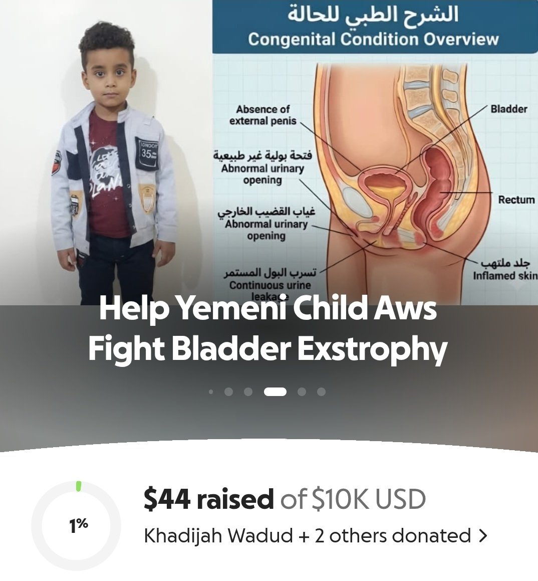 BilqisYeme6i's tweet photo. 💔 Every child deserves a chance to live with dignity.
Little Aws from Yemen is suffering from a rare congenital condition and urgently needs life-changing surgery.
Please donate or share. 🙏
#SaveAws #Yemen #Donate
👇🏻🙏🏻🇾🇪💔😔
https://t.co/I5evJmcj7N https://t.co/VH3hMR09zC