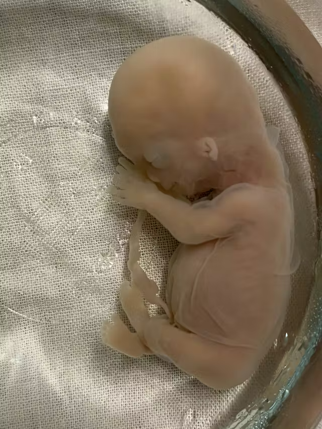 LiveAction's tweet photo. Caitlin miscarried at 12 weeks.

Her son was beautifully developed.
Her son had fingers, ears, and a face.

Her son was NOT just a clump of cells. https://t.co/tddhtaz3hj