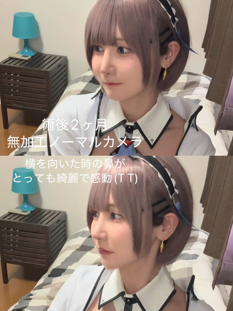 amane_azusa's tweet photo. 韓国のバンニ美容外科で目元と鼻の施術をして2ヶ月が経ちました！

普段よくコスプレをしているので、コンプレックスの目元にはアイテープ、鼻には鼻プチをしていましたが、目元はかぶれたり鼻は粘膜がやられてよく鼻血が出るようになっていました💦

正直ダウンタイムはきつかったですが、それ以上にコンプレックスを解消できた今がとっても楽しいです😆✨(普段のメイクもコスメイクも楽しすぎるぅ⊂(  ᴖ ̫ᴖ)⊃)

バンニさんは日本語ペラペラの通訳さんがいらっしゃったので、要望や不安なことなどもしっかり先生に伝えていただけたのでとても安心して施術に臨めました！

これは余談ですが、私がクリニックに初めて訪れた際現地のお客さんもたくさんいて、韓国でもとても人気なクリニックなんだと安心したのも覚えています😌

見た目のコンプレックスに悩み苦しんでいる人へ、整形という選択肢をとった私だから伝えられることを発信して、変わりたいと願うみんなに私から少しでも勇気を与えてあげられたらいいなって気持ちで投稿しました！
こちらの件については今後も定期的に発信するので、気になる方はまたチェックしてもらえたら嬉しいです☺️✨

可愛くなりたい、かっこよくなりたい皆へ
一緒に頑張ろうねー！！！！✊🏻🎀