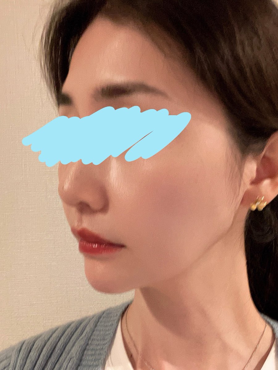 k___nikki's tweet photo. 5/19の半年検診の日に撮りました！
潮風にあたって髪ボサボサなので寄りの寄りで🙇🏻‍♀️ https://t.co/3tqrIlBPum