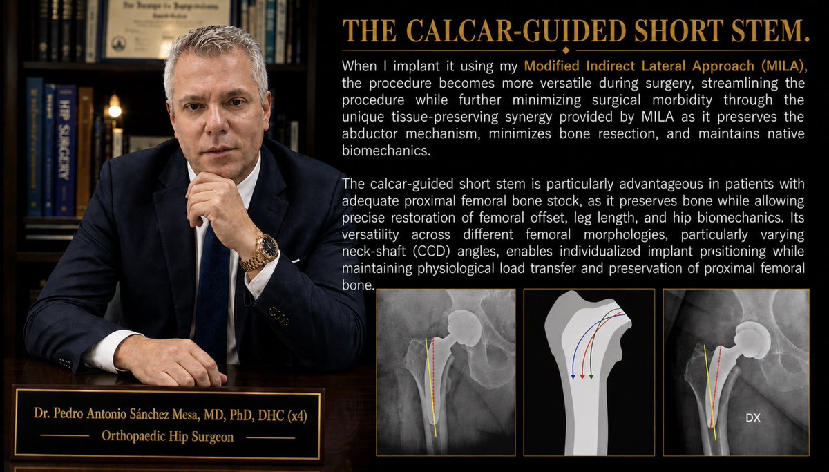 DrPasm's tweet photo. No todos los pacientes que requieren una #artroplastia total de #cadera necesitan el mismo vástago femoral. La selección del #implante adecuado comienza por comprender la anatomía del paciente y no por adaptar la anatomía al implante. https://t.co/SInFHNTR13
