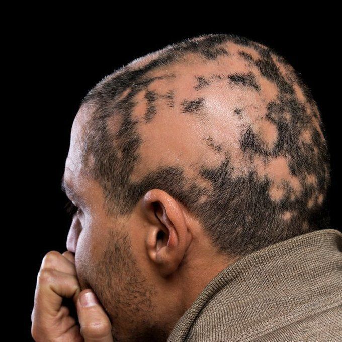 dominiorealXr's tweet photo. SEÑALES DE MASTURBACIÓN EXCESIVA EN HOMBRES:

No es un tema cómodo, pero tu CUERPO te avisa cuando estás abusando de tu energía.

1. Caída del cabello. https://t.co/okMJPatC5P
