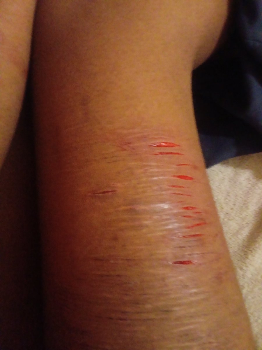 Mellzyyy_luvv's tweet photo. Old but I still like this one
#cuttwt #slittwt #ouchietwt #styro #styrocut #sfx #makeup #fakeblood #sharm #sharmtwt #cut #sh ALL FAKE SFX MAKEUP NOT REAL ALL AI AND MAKEUP DONE BY PROFFESSIONALS https://t.co/LuJYkDsEDR