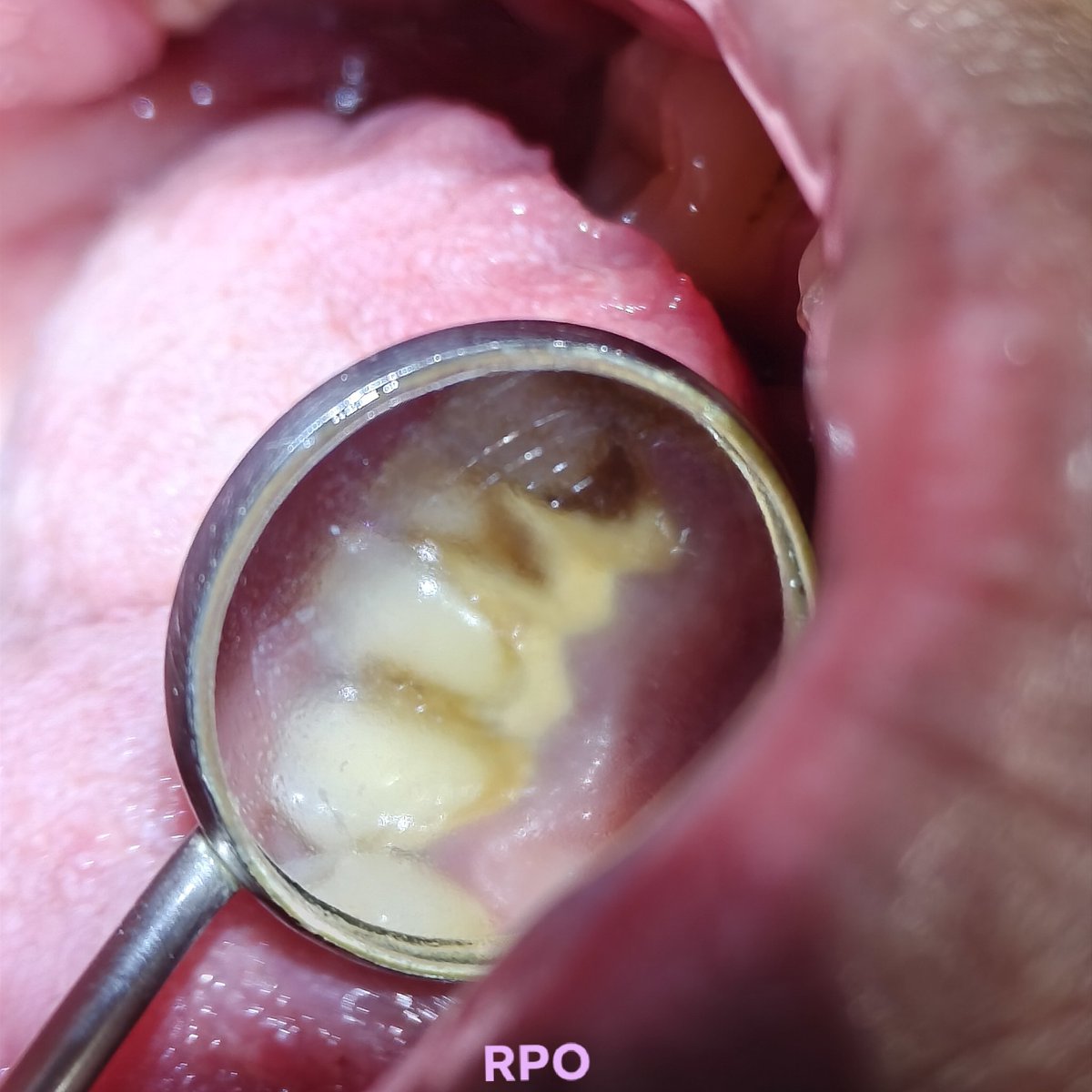 RakaiVDentist's tweet photo. Dimana tempat karang gigi paling banyak menumpuk buat sebagian besar orang?

Jawabannya adalah di gigi bawah depan pada permukaan dekat lidah (lingual)

Coba rasakan pke ujung lidah kalian

Kenapa?
Apa dampaknya?
Gimana cara mengatasinya?
Gimana cara mencegahnya? 

Yuk kita bahas https://t.co/derKwGHZW1