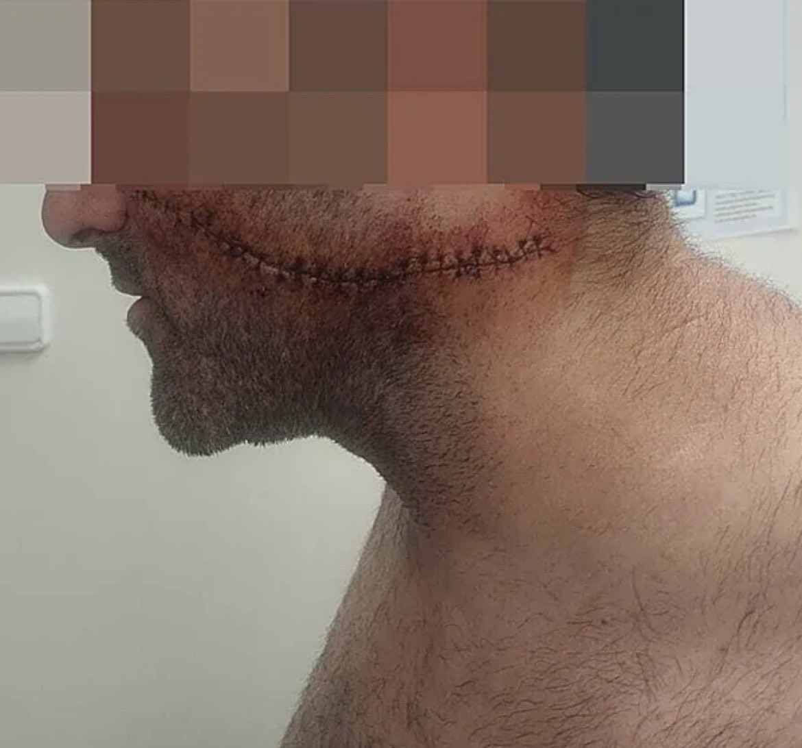 contrastado's tweet photo. Un magrebí de 25 años le raja la cara con un cuchillo a un hombre de 45 en Málaga mientras esperaba sentado en un banco para entrar a trabajar.
Necesitó 30 puntos de sutura y casi le corta la yugular.
Minutos antes había intentado robar a una mujer en una heladería.
…Basta YA!!! https://t.co/zr5PLelU0l