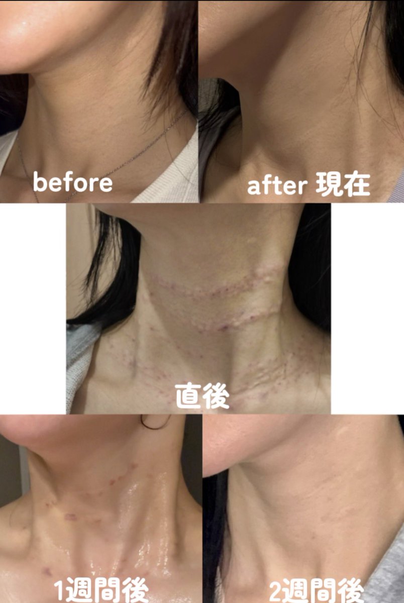 canny_118's tweet photo. 韓国江南駅やシンノヒョン駅から歩いて行けるディアルクリニック@diarclinic_jp 
首の細かいシワまで丁寧に見てくれる女医さん。なかなかここまで首のシワに向き合ってくれる先生いない。首フィラーや首ヒアルが気になっている人は検討してみて。 https://t.co/ecoaEz0y3K