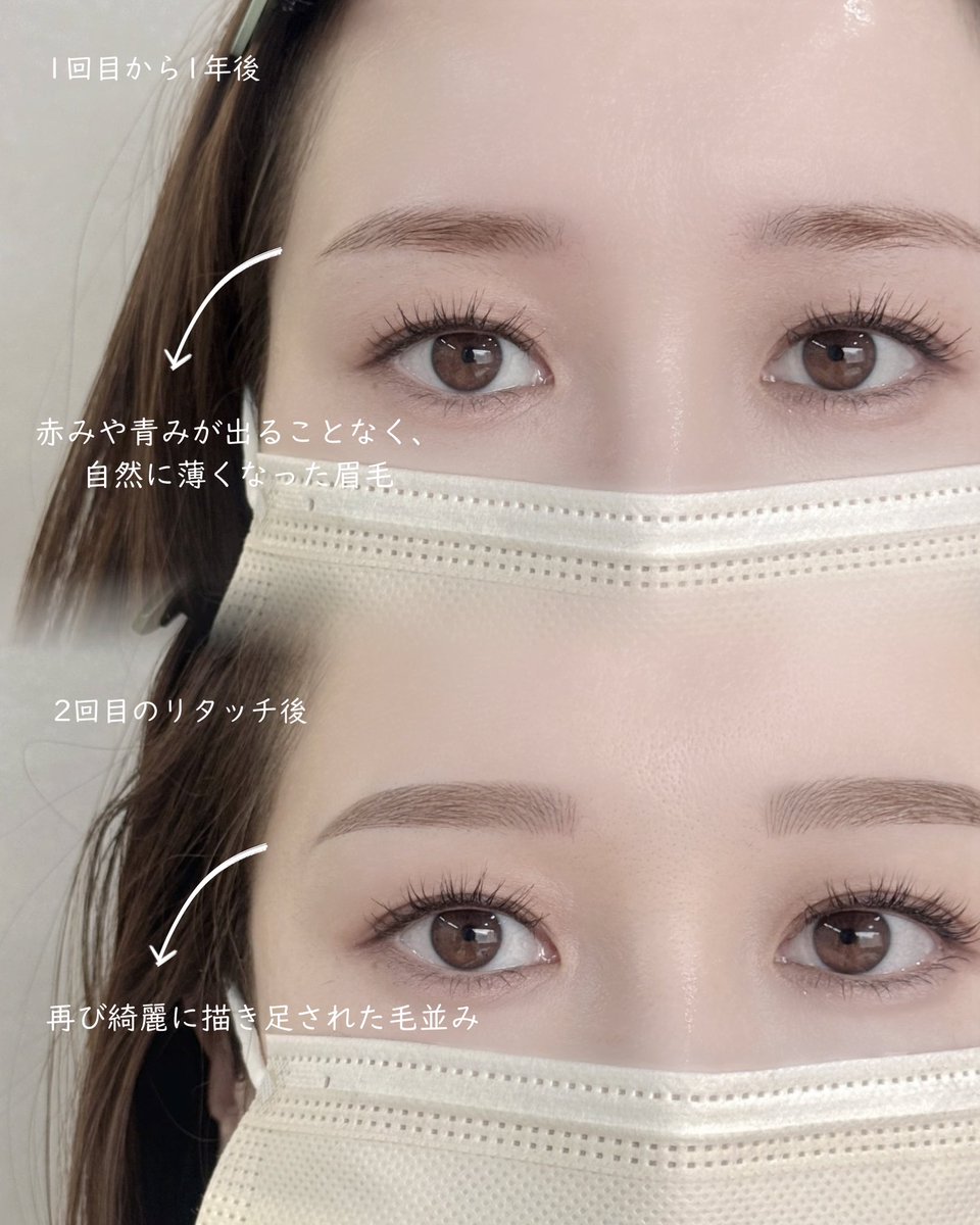 Somimi_Brow's tweet photo. 1回目のご来店から約1年後。
リタッチでお越しくださったお客様✨

赤みや青みが出ることなく、自然に薄くなった眉毛。

今回のリタッチでは毛並みを一本一本描き足し、さらに完成度の高い仕上がりに🤍＊.

#somimibrow #眉毛アート　#眉毛アートメイク　#韓国メイク　#美容 https://t.co/HtBbCQ2Pb3