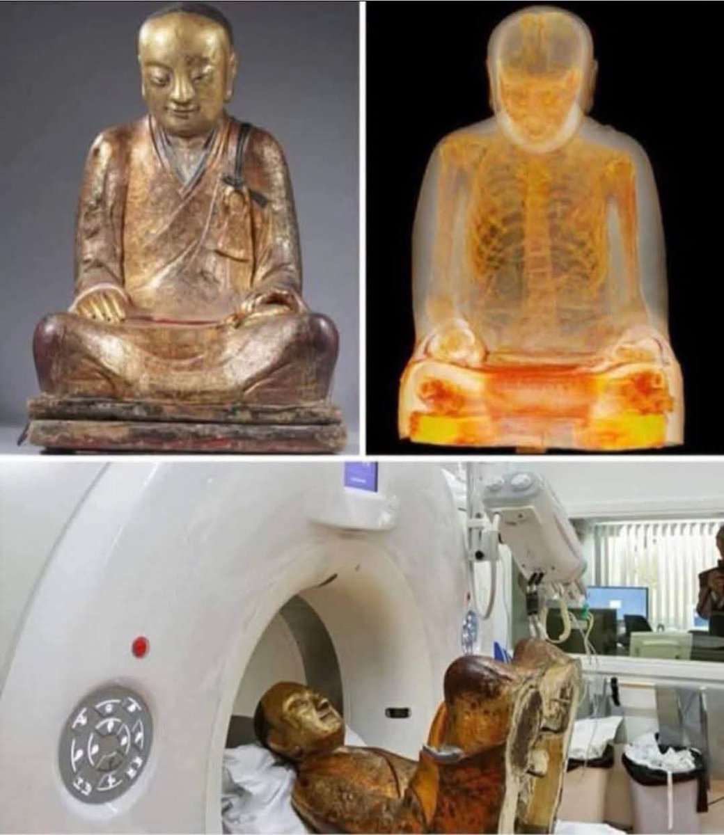 4biddnKnowledge's tweet photo. CT Scan Reveals Mummified Monk Inside Ancient Buddha Statue. A medical examination of a 1,000-year-old Buddha statue has revealed a shocking surprise hidden inside. Researchers found tissue and bone, indicating he likely underwent the arduous process of self-mummification in an attempt to reach a revered spiritual state. The remains are believed to be Buddhist Master Liuquan of the Chinese Meditation School, who died around A.D. 1100.The Organ Replacement: The monk's internal organs were carefully removed and replaced with rolls of paper containing ancient Chinese writing. Some practicing Buddhists hold the spiritual belief that mummified masters are not biologically dead but are instead in an advanced state of deep meditative focus. However, scientifically speaking, the monk is completely deceased and the cells are entirely dead.