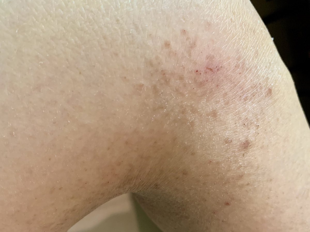 syouko_rin's tweet photo. 残念ながら『1年間悪化なし』の目標は達成できなかったけど痒みも湿疹も確実に減少してきてる

去年最後に撮影した左脚も自然治癒で綺麗に治った

今はGWまで綺麗だった右脚がこんな状態↓になってしまったけど、たまに痒くなる程度なので自然に治るのを気長に待とう https://t.co/TmzgZYRuyR