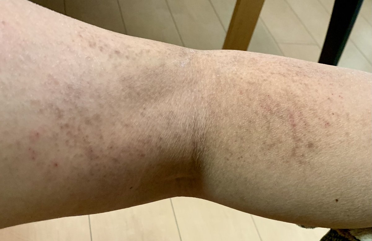 syouko_rin's tweet photo. 残念ながら『1年間悪化なし』の目標は達成できなかったけど痒みも湿疹も確実に減少してきてる

去年最後に撮影した左脚も自然治癒で綺麗に治った

今はGWまで綺麗だった右脚がこんな状態↓になってしまったけど、たまに痒くなる程度なので自然に治るのを気長に待とう https://t.co/TmzgZYRuyR