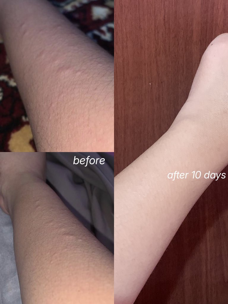shalsabilsz's tweet photo. BUKAN LOTION BIASA TP THIS ONE REALLY SAVE MY SKIN!!🥇
kulit ku yang sering bgt kambuh eksim nya jadi lebih lembut dan tenang hanya dalam 10 hari, ini dia yang bikin perbedaan besar buat kulit sensitifku!💗 dan sudah aman digunakan mulai dari umur 10 tahun!!🫰🏻 https://t.co/eEYzt6XBzj