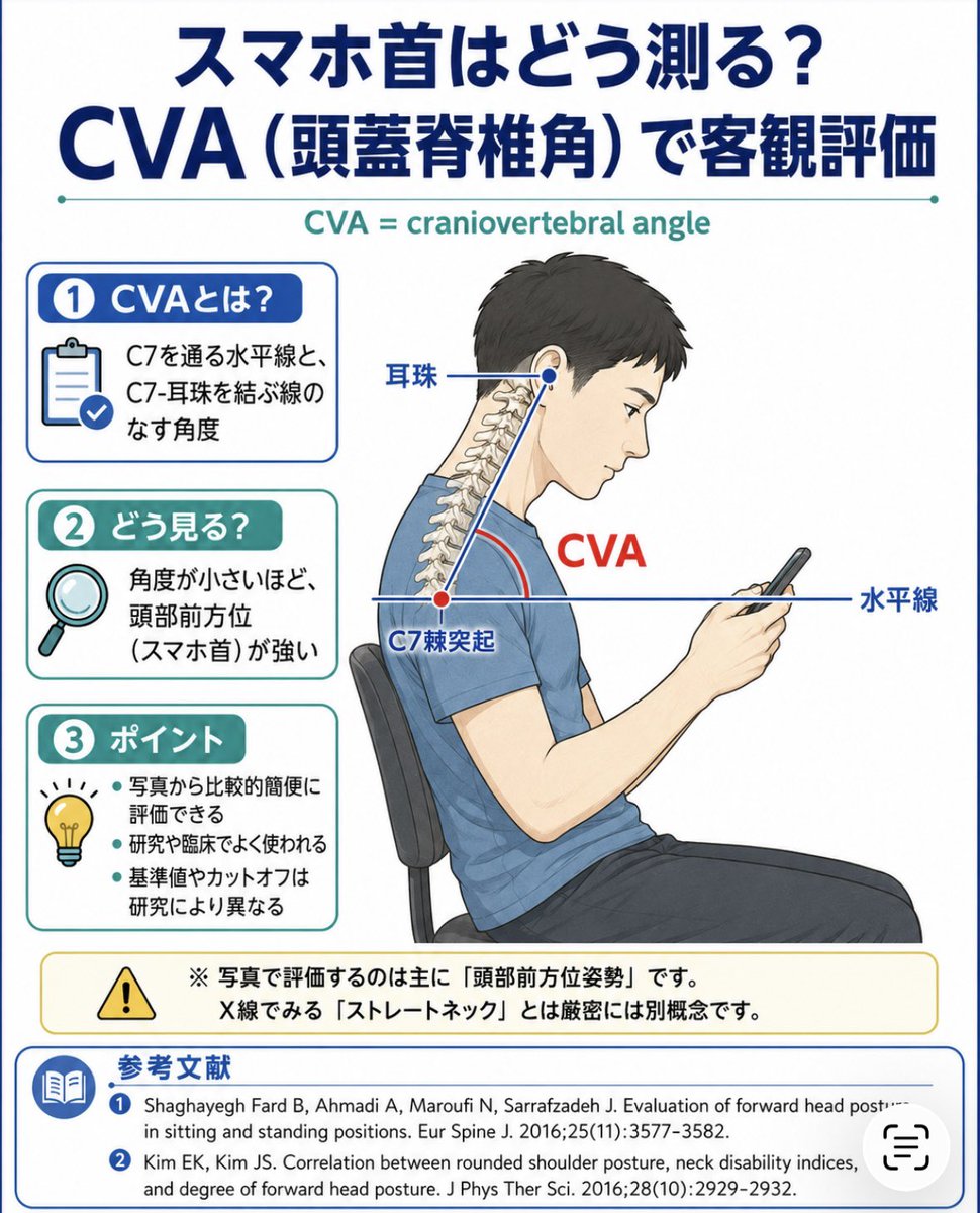 Tashiro__D's tweet photo. スマホ首・ストレートネックを客観的にみる指標として、CVA（craniovertebral angle：頭蓋脊椎角）があります。

CVAは、C7棘突起を通る水平線と、C7から耳珠を結ぶ線のなす角度。

角度が小さいほど、頭部前方位姿勢が強いと解釈されます。

写真から比較的簡便に評価できるため、研究や臨床でも用いられています。

ただし、写真で評価しているのは主に「頭部前方位姿勢」であり、X線でみる「ストレートネック」とは厳密には別概念です。

参考論文：
1. https://t.co/APB2K6inCf
2. https://t.co/KoNdyiAhUD