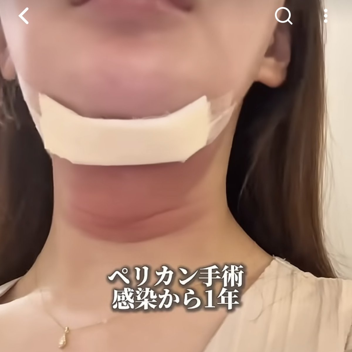 biyou_onnie's tweet photo. ペリカン手術・顎下脂肪吸引って感染することあるの！？😭
たまたま流れてきた動画見てびっくりして、今月末に手術控えてるから慌てて感染対策調べた...。

✔︎傷口は清潔に保つ・触らない
✔︎抗生物質は絶対飲み切る
✔︎術後1ヶ月は飲酒・喫煙NG
✔︎少しでも異変を感じたらすぐクリニックへ
→韓国の場合は提携先の病院を事前に確認
→提携先がない場合は対応できる病院を術前に調べて���く

手術まであと30日🏥