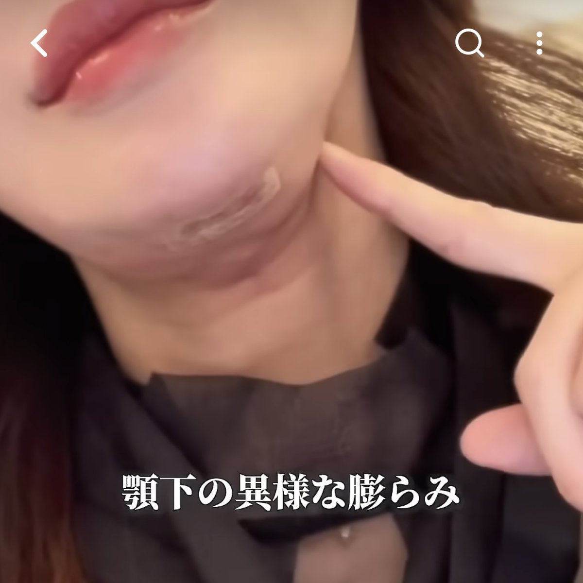 biyou_onnie's tweet photo. ペリカン手術・顎下脂肪吸引って感染することあるの！？😭
たまたま流れてきた動画見てびっくりして、今月末に手術控えてるから慌てて感染対策調べた...。

✔︎傷口は清潔に保つ・触らない
✔︎抗生物質は絶対飲み切る
✔︎術後1ヶ月は飲酒・喫煙NG
✔︎少しでも異変を感じたらすぐクリニックへ
→韓国の場合は提携先の病院を事前に確認
→提携先がない場合は対応できる病院を術前に調べて���く

手術まであと30日🏥
