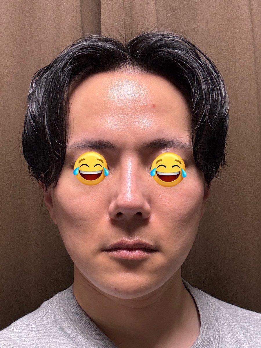 seikei_shine's tweet photo. フル切開リフトの経過。
←左:ビフォー
→右:アフター（施術から約1年半）

たるみが戻ることもなくずっと経過良好。やって良かった。 https://t.co/VLtjLGj6wy