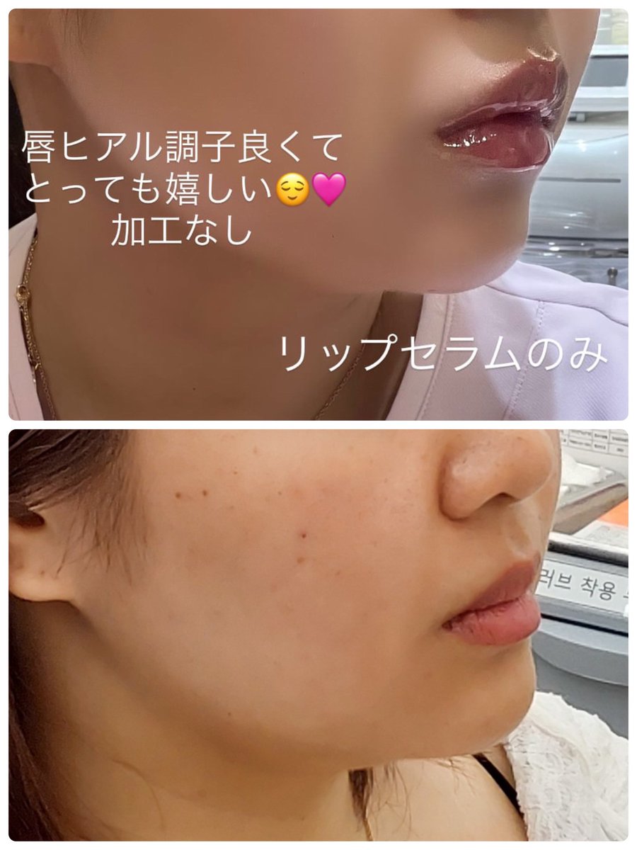 YuiChama_U's tweet photo. プムクリニック明洞店で唇フィラー1cc受けてきました🩷✨

大大大満足！💋
正面とななめです！
M字と口角あげてもらいました！
左右差も改善されてて嬉しい☺️
@ppeumclinic__jp https://t.co/6n84JtlAjE