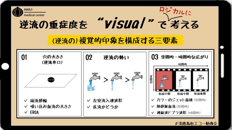 jun_awaji's tweet photo. 📌 #淡路島心エコー勉強会
「逆流の重症度」の "印象”を構成する三つの要素とは？

１．吸い込み血流の大きさ
２．逆流の勢い
３．持続時間

「太い蛇口を、いっぱい捻って、しかも出しっ放し」にすれば、水の総量 (逆流量) は多くなるはず…。
3つの組み合わせで"印象”を形作っているよう… https://t.co/Gz4Vn8KmpA