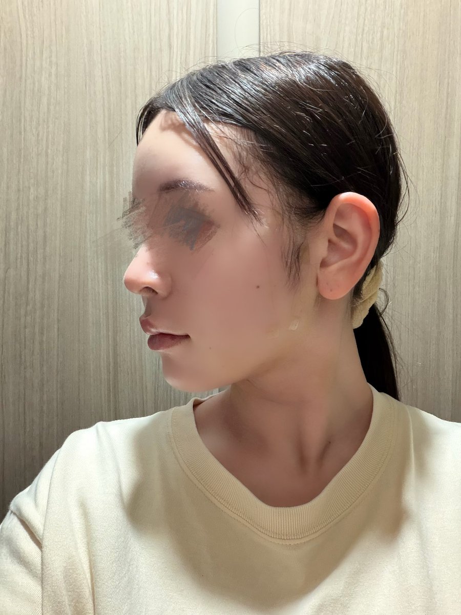 33333pyo's tweet photo. 【DU美容外科さん】
今回お願いした施術⤵️

DUシルエット輪郭術2段階
首の筋肉下脂肪吸引
バッカルファット除去
エラボトックス
脂肪移植（ほうれい線）
糸リフティング 
チークリフティング
@dups_jp
術後7日目レポ ❣️ https://t.co/BK5fRFaO0w