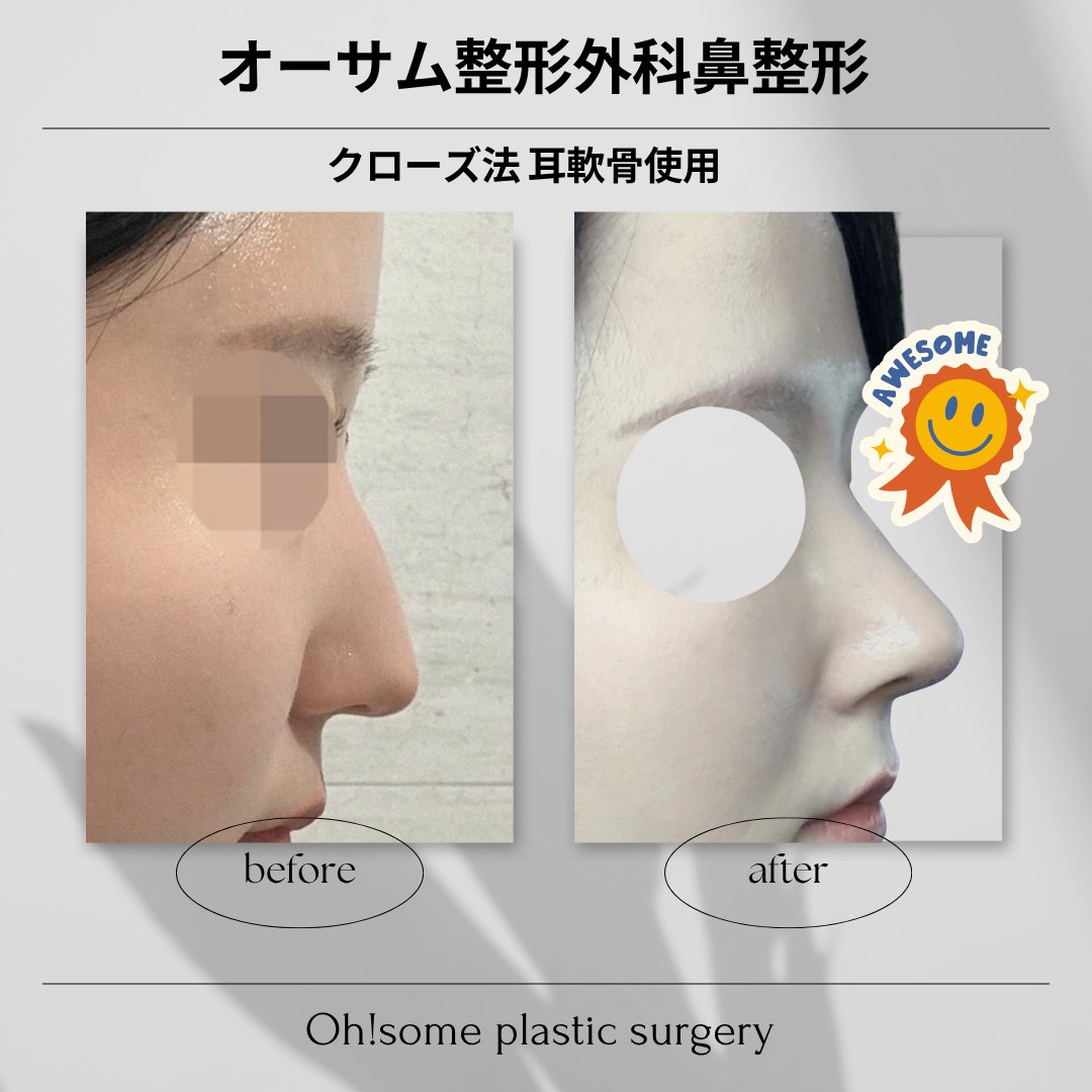 Ohsome_ps's tweet photo. オープンしないNOプン❗オーサムのクローズ鼻整形でナチュラル可愛く😆

DT短めで嬉しいノープン法💝

お写真カウンセリング可能です🫰

📩 LINE相談 → https://t.co/8Gq5dAAg8X

#忘れ鼻 #ナチュラル整形 #渡韓整形 #韓国美容 #鼻整形 #現地人気 #耳介軟骨 #鼻尖形成 https://t.co/sJAP7WWVz0