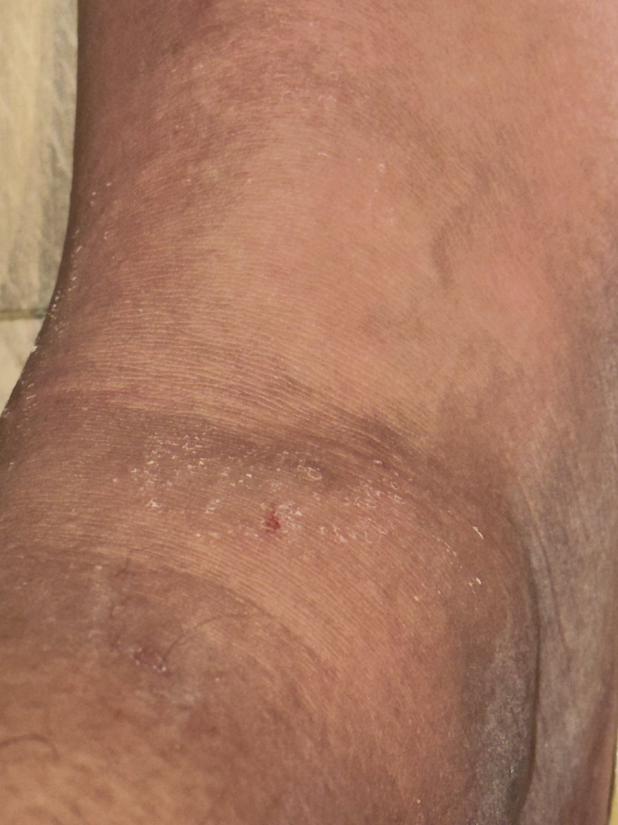 queerisy's tweet photo. jujur tersiksa banget punya kulit badan yang sensitif jadi dikit-dikit gatel dan gak tahan buat garuk sampai kadang luka dan periiih tapi yang paling nyebelin bekasnya itu loh yang susah dihilangin nanti 😞😞

ada yang sama gak kondisi kulitnya kaya aku…? https://t.co/lP3N7QdZeF