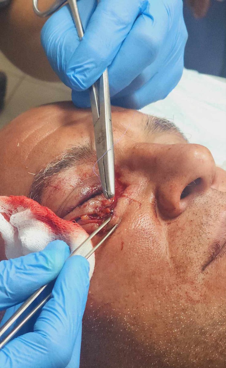 lamis_hamad5's tweet photo. A few days separate these two photos.. The first was taken before the injury, and the second documents the initial moments of my injury in the war, which caused me to lose my sight.
Help me restore my sight.👇🙏
https://t.co/Z9St36CSGw https://t.co/tupGqgxTB9