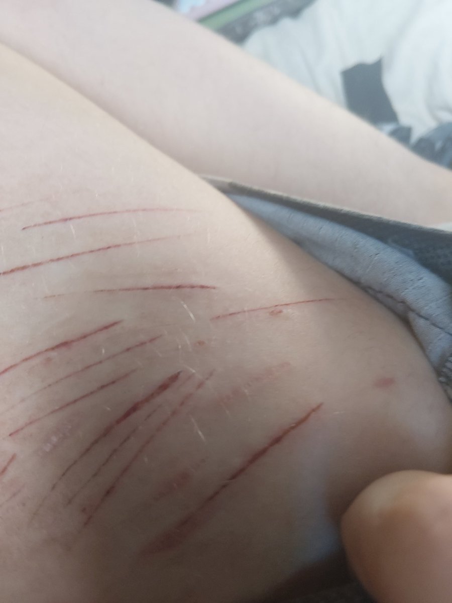Sylvieon_5's tweet photo. I've been cutting a lllooott recently but never actually having a chance to take pics so have these I took yesterday most of them r fresh #sh #shtwt #slit #slittwt #styro #owchie #sfx #notreal #fake https://t.co/OYONwZgzOh