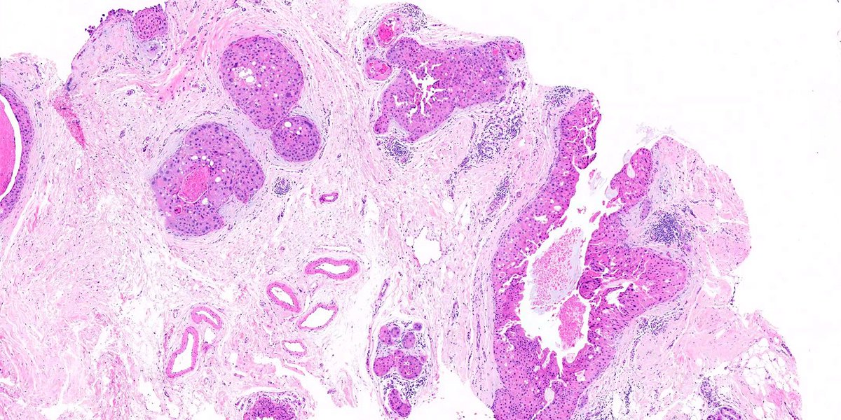 RazaHoda's tweet photo. Apocrine DCIS ๐๐ฌ
Intraductal proliferation of markedly atypical apocrine cells with abundant eosinophilic granular cytoplasm, prominent nucleoli, and central necrosis.
#PathX #PathTwitter #breastpath https://t.co/EKRuruy9oj