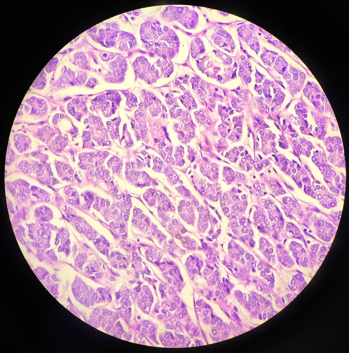 SyedSal55391459's tweet photo. #histopathology
#thyroid
#pathX
#pathTwitter
#photomicrograph

Dx: Follicular variant of papillary carcinoma. https://t.co/J2gPfmqZBE