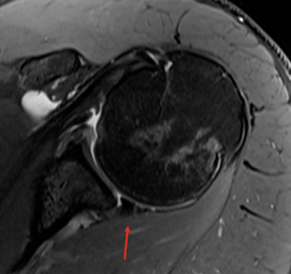 MillettMD's tweet photo. Standardized repairs aren't only path for posterior #shoulderinstability. Study in @ArthroscopyJ by Dr Millett/colleagues examines return to competition &amp; recurrence in elite athletes. Better question: what does this injury mean for the athlete?https://t.co/93av0MR5wl #medtwitter https://t.co/f8Pb2hdgkA