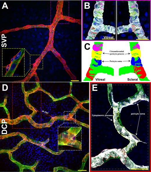 ARVOiovs's tweet photo. Chandrakumar Balaratnasingam et al from Lions Eye Institute find that degeneration of interpericyte tunneling nanotubes can occur in the absence of pericyte loss in diabetic retina disease. 
https://t.co/jfOopTUyx4 https://t.co/ilgMaR9tDv