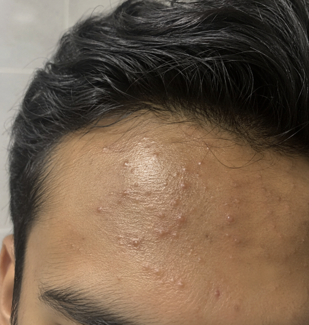dr_sheena_derm's tweet photo. Had a patient with acne on forehead since a year. He used clindamycin and benzoyl peroxide for months, with no improvement.
He was ready to give up but decided to book a consult with @dermatnow .

So we looked closer.

Acne or fungal acne?

And here's how we treated it in a month https://t.co/f5o7YLeIMU