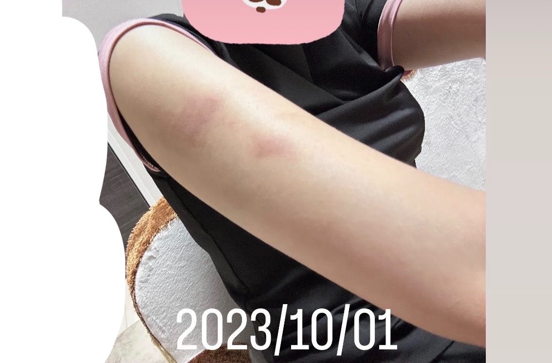 ramupichan's tweet photo. 骨スト二の腕デブ問題は脂肪吸引で解決
⬅️ピラティス通ってたのに二の腕太いw https://t.co/Enk98MZbZl