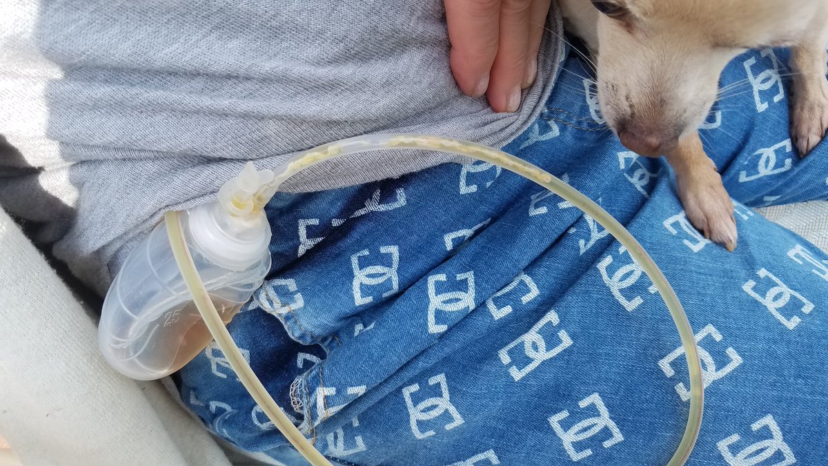 LacyCheryl27988's tweet photo. @r_hirschman Here is a pic of my friends JP drain post mastectomy for breast CA (2 pfizer jabs) with white fibrous clots. I am a surgical nurse and have worked with JP's for years and never saw this in one before. https://t.co/lCj3Zpg3KX