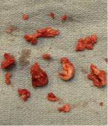 BekaBakhtadze's tweet photo. Just presented a case of Harmony TPV MSSA infective endocarditis managed fully percutaneously @ #NYvalves:
Initial vegetectomy with #angiovac for obstruction, followed by a #P4010 Palmaz to optimize the landing zone for a successful #26S3 ViV in a #22Harmony 2 years later https://t.co/O48TNWiH8H