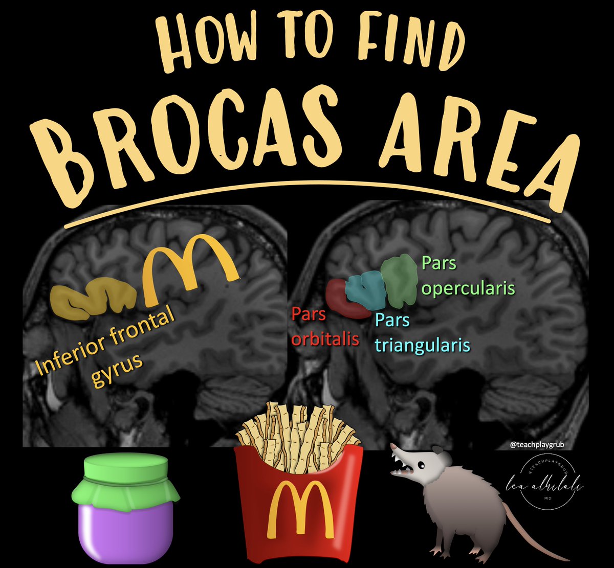 teachplaygrub's tweet photo. 1/Do you get a Broca’s aphasia trying remember the location of Broca's area?

Does trying to remember inferior frontal gyrus anatomy leave you speechless?

Don't be at a loss for words when it comes to Broca's area

Here how to remember the anatomy of this key region! https://t.co/VawF97lW7x