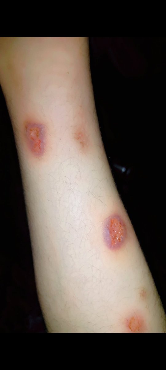 AnnaSafa2999's tweet photo. @lozanty Our situation in the tents is tragic. We're not asking for palaces, just medicine to stop this small army of insects, so we can at least have some skin left to cover our weary bones. We need $70 for the medicine, please. https://t.co/wyzW5FbHaM