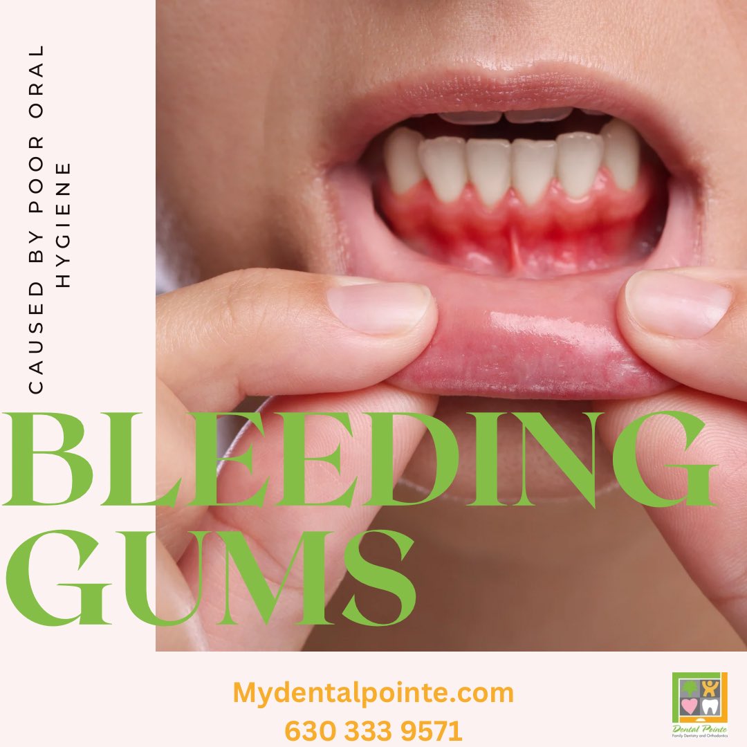 DentalPointe's tweet photo. Bleeding gums are most commonly caused by gingivitis (early gum disease) or plaque buildup along the gumline due to inconsistent flossing. Schedule your oral hygiene appointment today before the problem gets worse ! #dentalpointe #napervilledentist #AuroraDentist https://t.co/fKrhNMCRIt