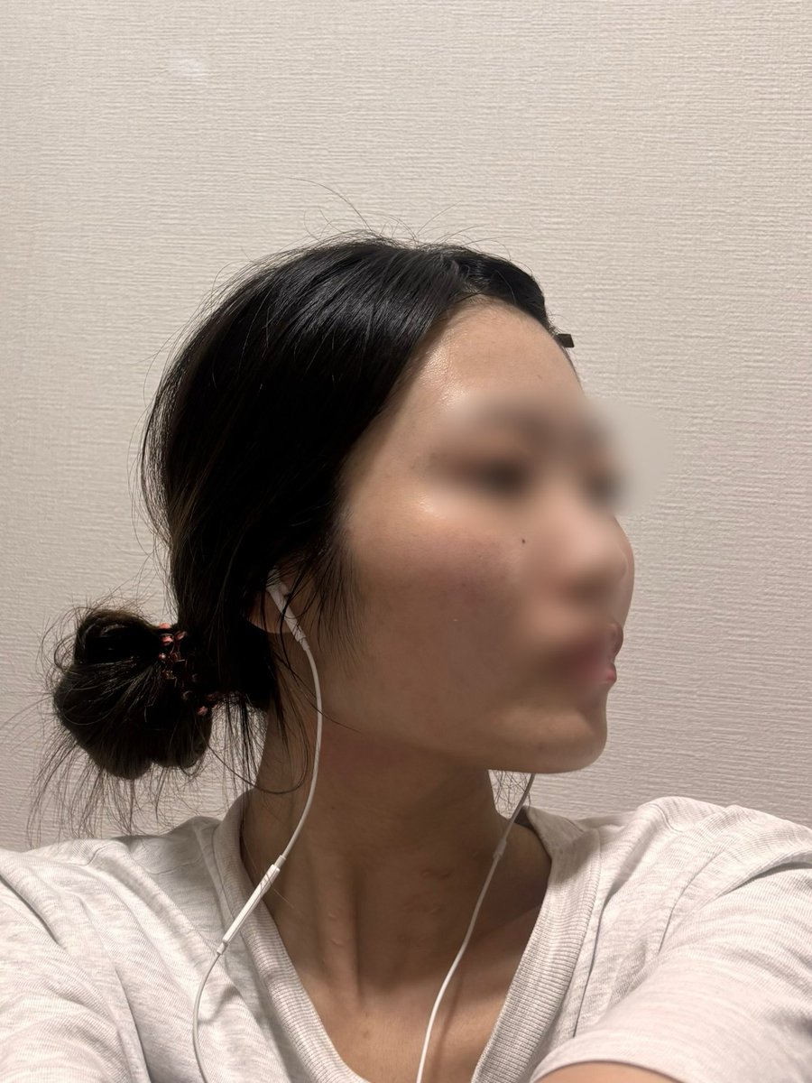 na7nnl's tweet photo. 外カメノーマル、こう見ると正面からはエラあんまり四角くはってないけど、横からの骨感、耳から顎にかけてのラインがやっぱ気になる
あと頬骨も外に張ってるからそこで余白が余計に出来てるよね？💧調べれば調べるほど何するべきか分からなくなるね https://t.co/dbCSixKfWj