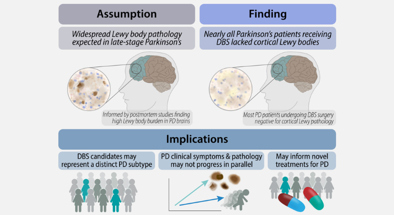 AIHealthMtSinai's tweet photo. PRESS RELEASE!

@IcahnMountSinai researchers' study finds little to no cortical Lewy pathology in living Parkinson's Disease patients undergoing deep brain stimulation.

Read more: https://t.co/GNWmgUjSJf

Full study in @Nature_NPJ Parkinson's Disease: https://t.co/mcaHNeKRs1 https://t.co/RS1OQvFw6W