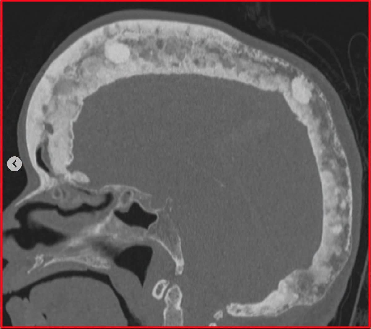 hemo_shk's tweet photo. A patient presents with headaches, hearing loss, and says their hat no longer fits.

❓ What is the most likely diagnosis? https://t.co/wa7RCziat9