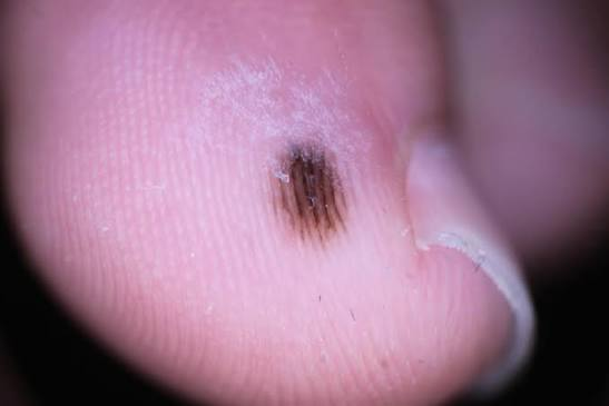 biovaxys's tweet photo. The proposal for our collaboration with PI Carman Giacomantonio, MD, of Dalhousie University for the CDMRP Rare Melanoma Program targeting acral melanoma is complete and under University review prior to submission. #Acral #melanoma is a very aggressive subtype of skin cancer that forms on the palms of the hands, soles of the feet, or under the fingernails. Unlike ‘typical’ melanoma, it is not caused by sun exposure and delayed treatment can lead to function-altering surgery or amputation. Our joint hypothesis is that acral melanoma tumors conditioned with Sona Nanotech’s THT will become more susceptible to BioVaxys’ MVP-S-driven survivin-specific T-cell immunity, and that anti-PD-1 checkpoint inhibition will sustain this response. This could present a major breakthrough in acral melanoma therapy.