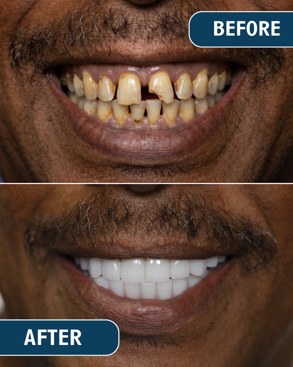 fusionfullarch's tweet photo. If this sounds like you, we're here to answer your questions, provide honest guidance, and help you feel confident every step of your smile journey.

Send us a message. We're happy to help! 
#dentalimplantscostcalifornia #allon4cost #permanentteethcost #dentalimplantquestions https://t.co/s7AWSCPIdB